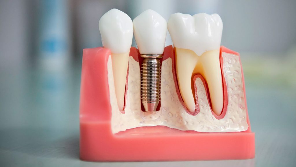 імплантація зубів Київ